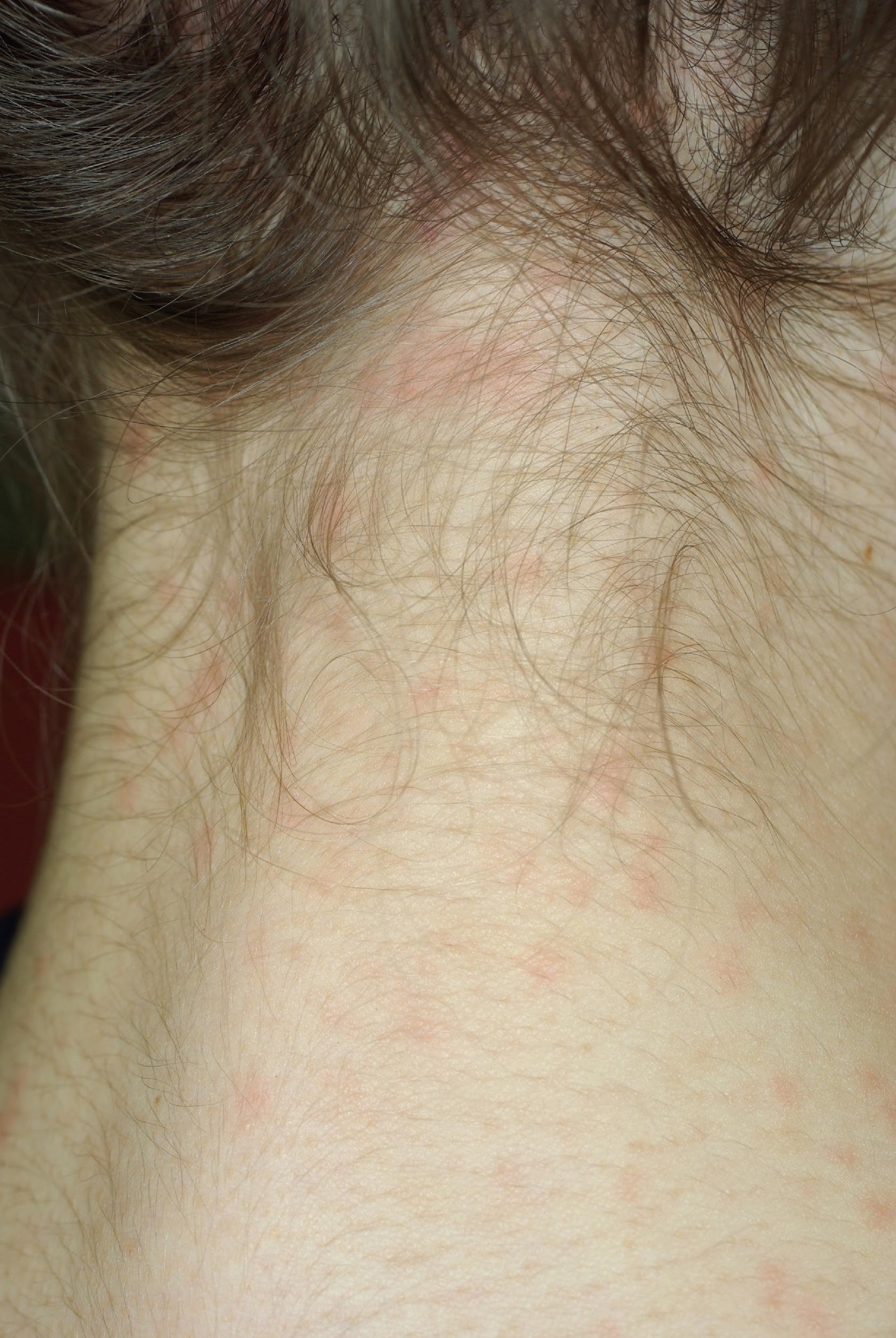 tout-savoir-sur-les-poux-de-t-te-dermato-info