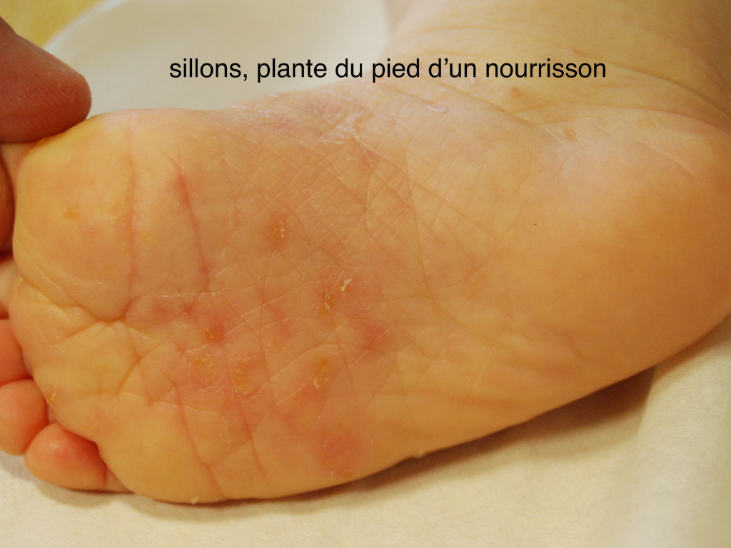 Gale, sillons chez un enfant