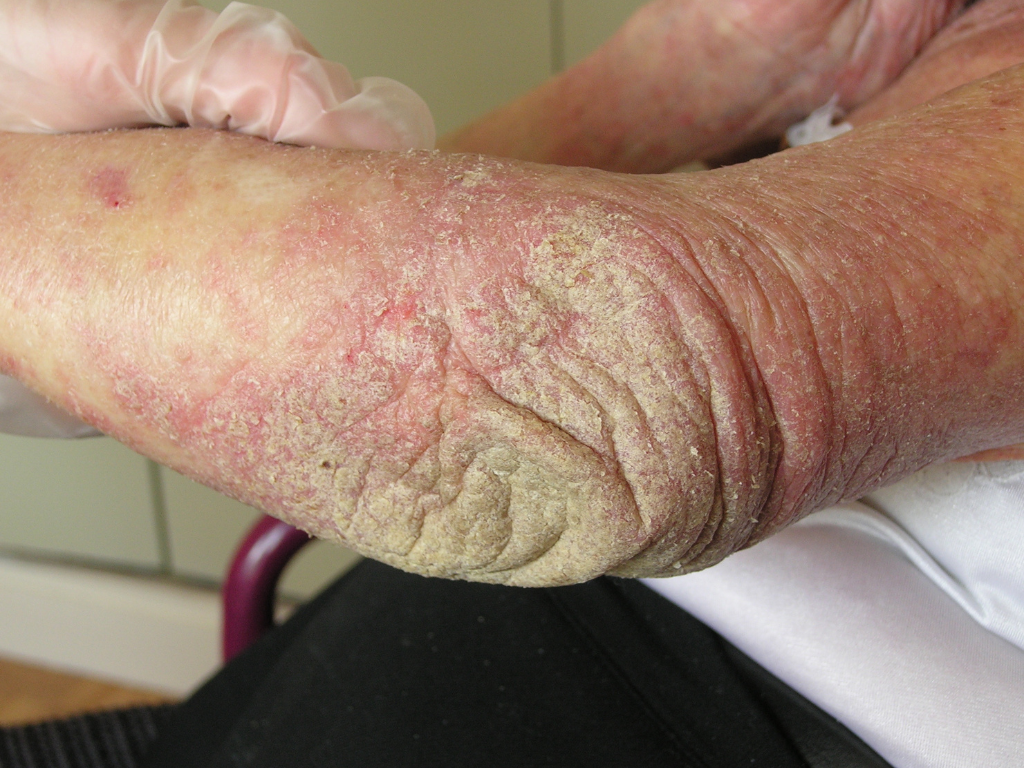 Gale hyperkératosique