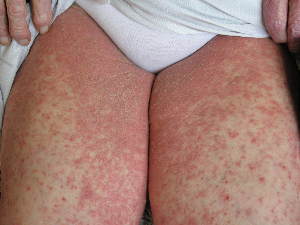 Gale hyperkératosique