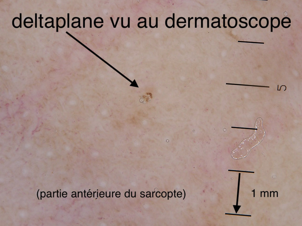 Deltaplane, partie antérieure du parasite