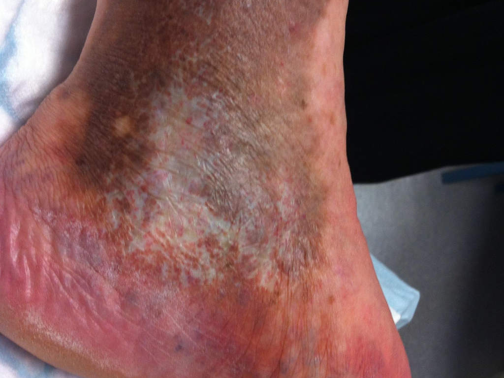 Altérations cutanées C4A ou C4B+