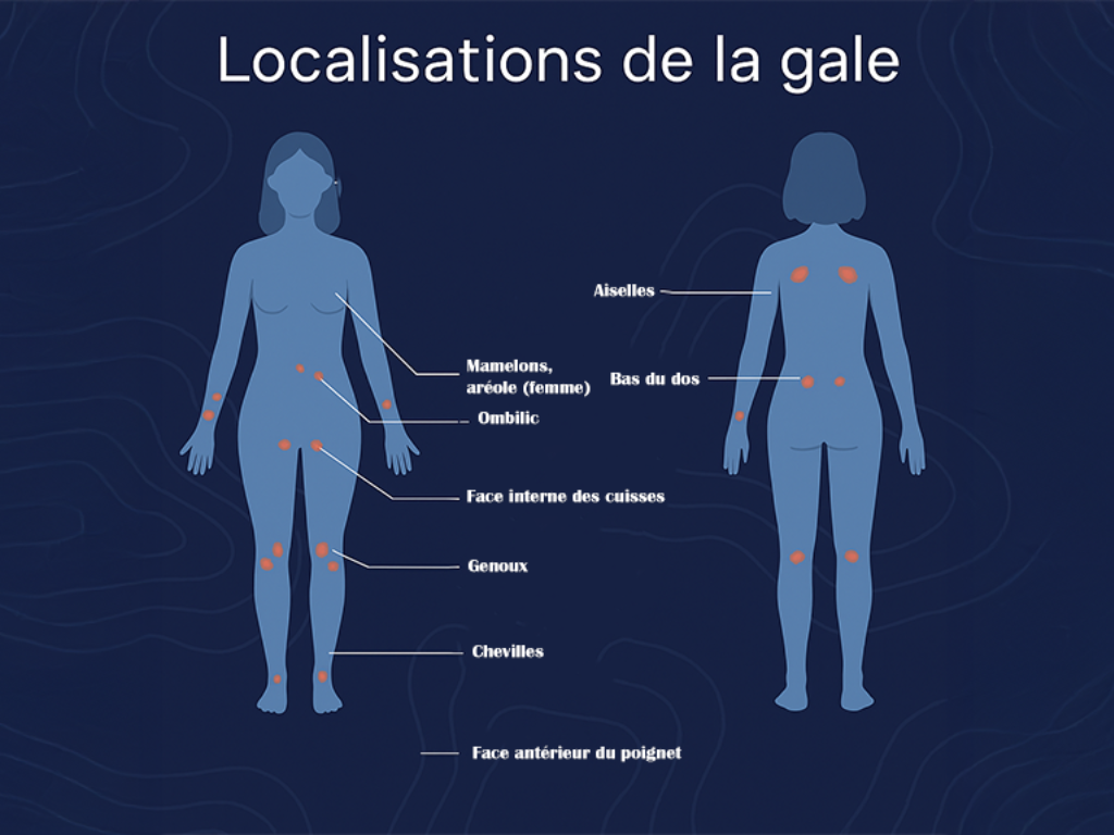 Localisation de la gale