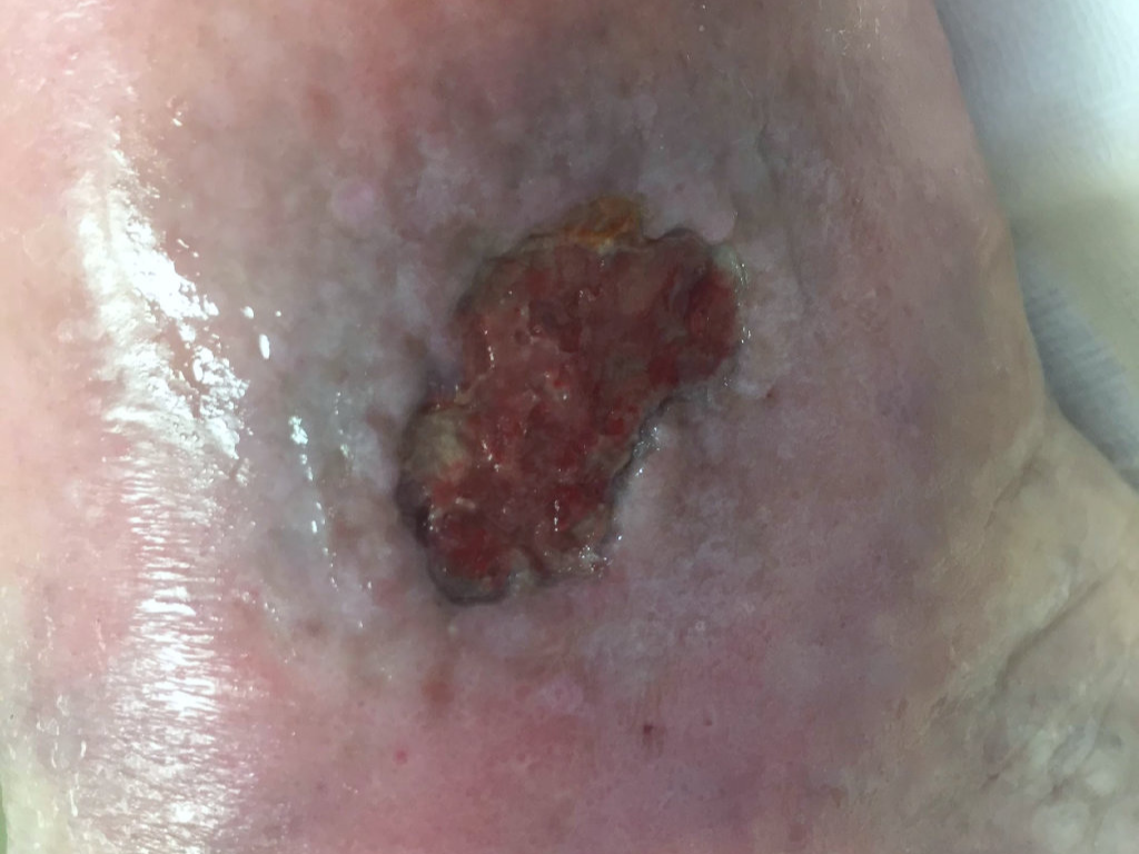 Altérations cutanées C4A ou C4B+