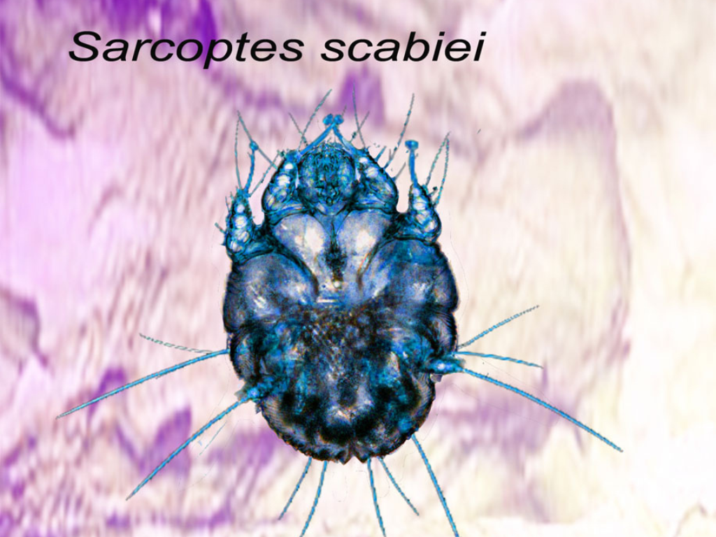 Gale : sarcoptes scabiei
