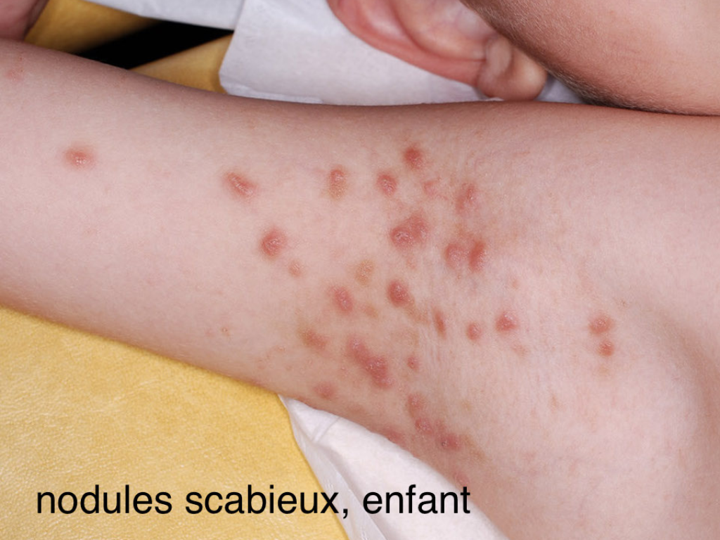 Gale,nodule scabieux chez un enfant