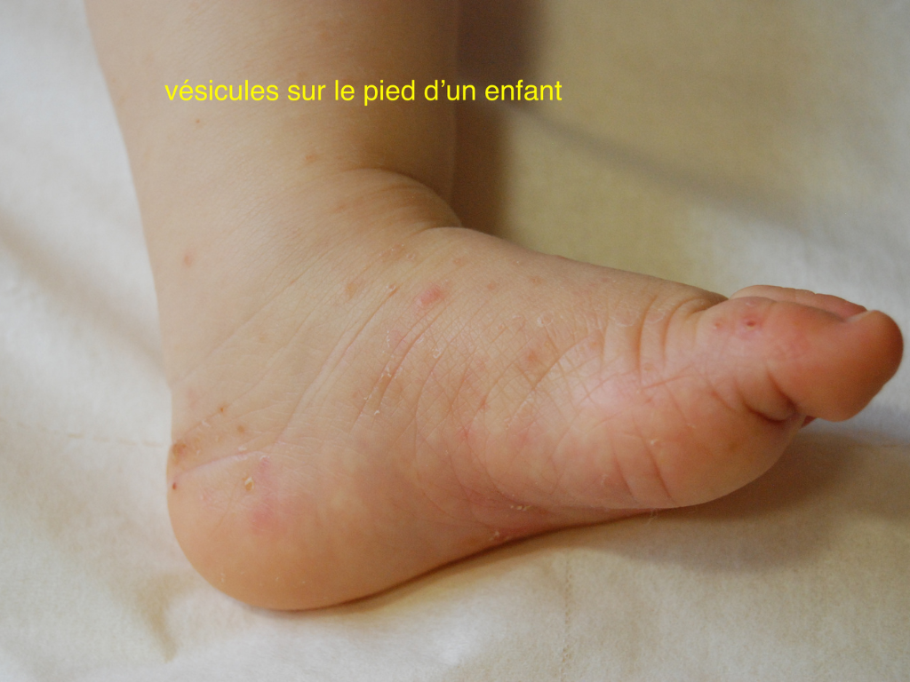 Gale, vésicules chez un enfant