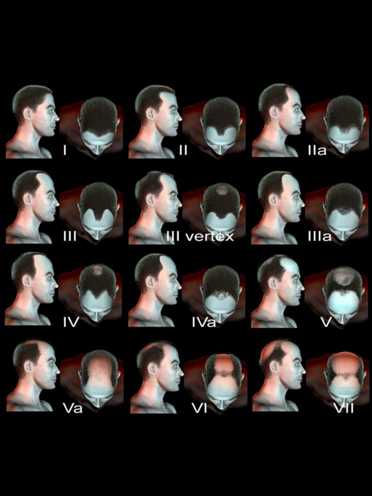 Classification américaine de l'alopécie androgénique
