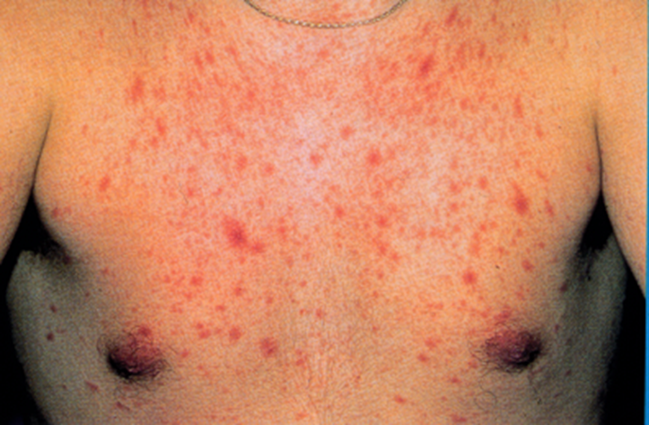 Manifestations cutanéo-muqueuses de la primo-infection à VIH