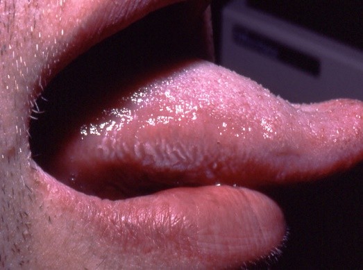 Leucoplasie orale chevelue.