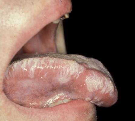 Leucoplasie orale chevelue.