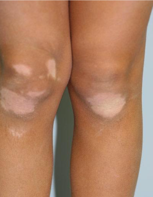 Vitiligo vulgaire