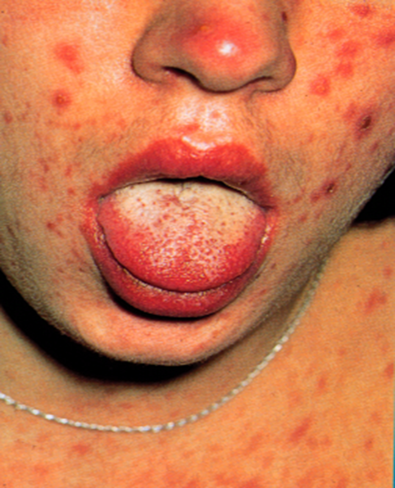 Manifestations cutanéo-muqueuses de la primo-infection à VIH