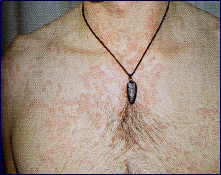 Manifestations cutanéo-muqueuses de la primo-infection à VIH