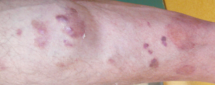 Lésions de sarcome de Kaposi chez une personne atteinte par le VIH.