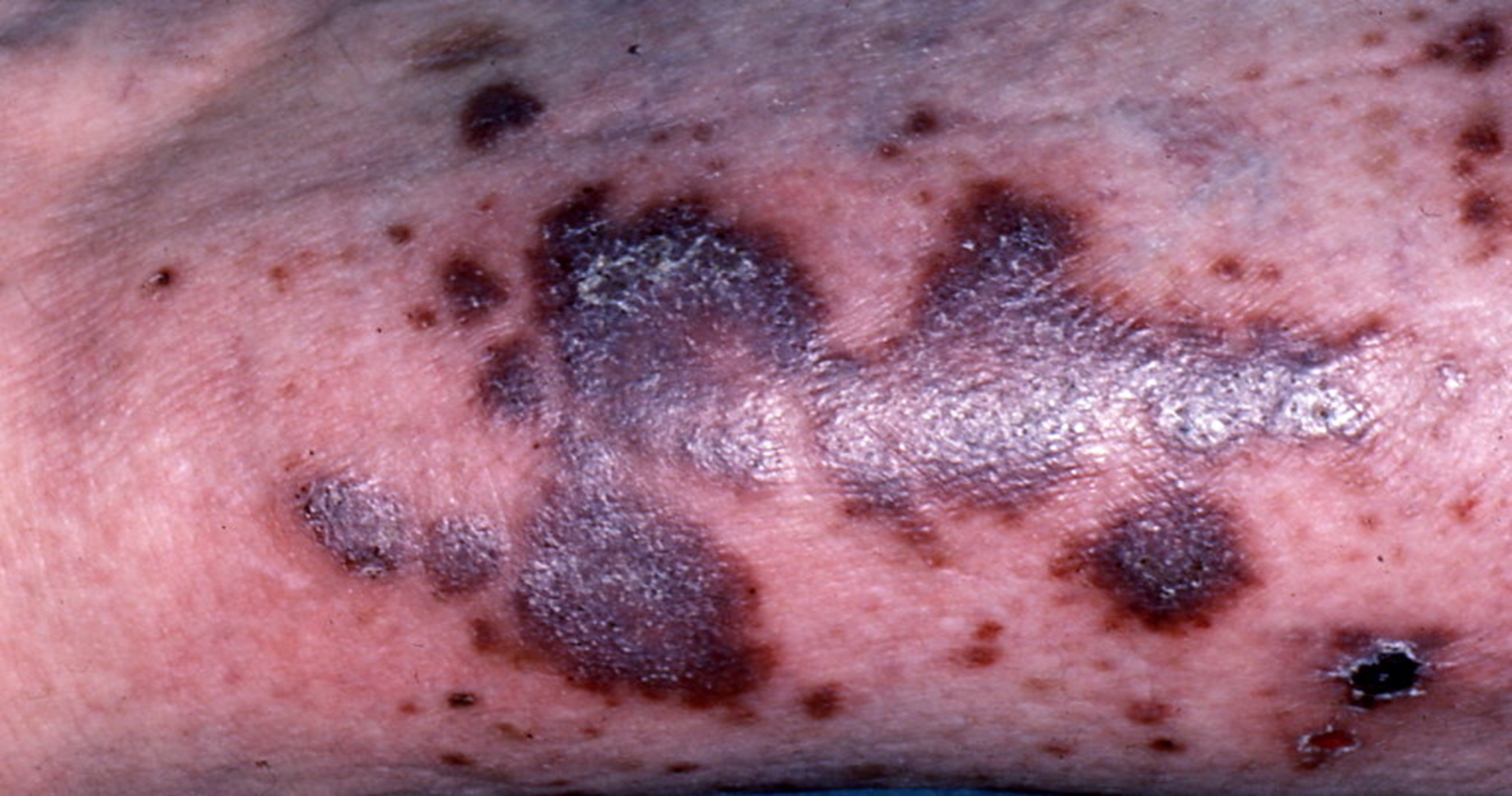 Lésions de sarcome de Kaposi chez une personne atteinte par le VIH.