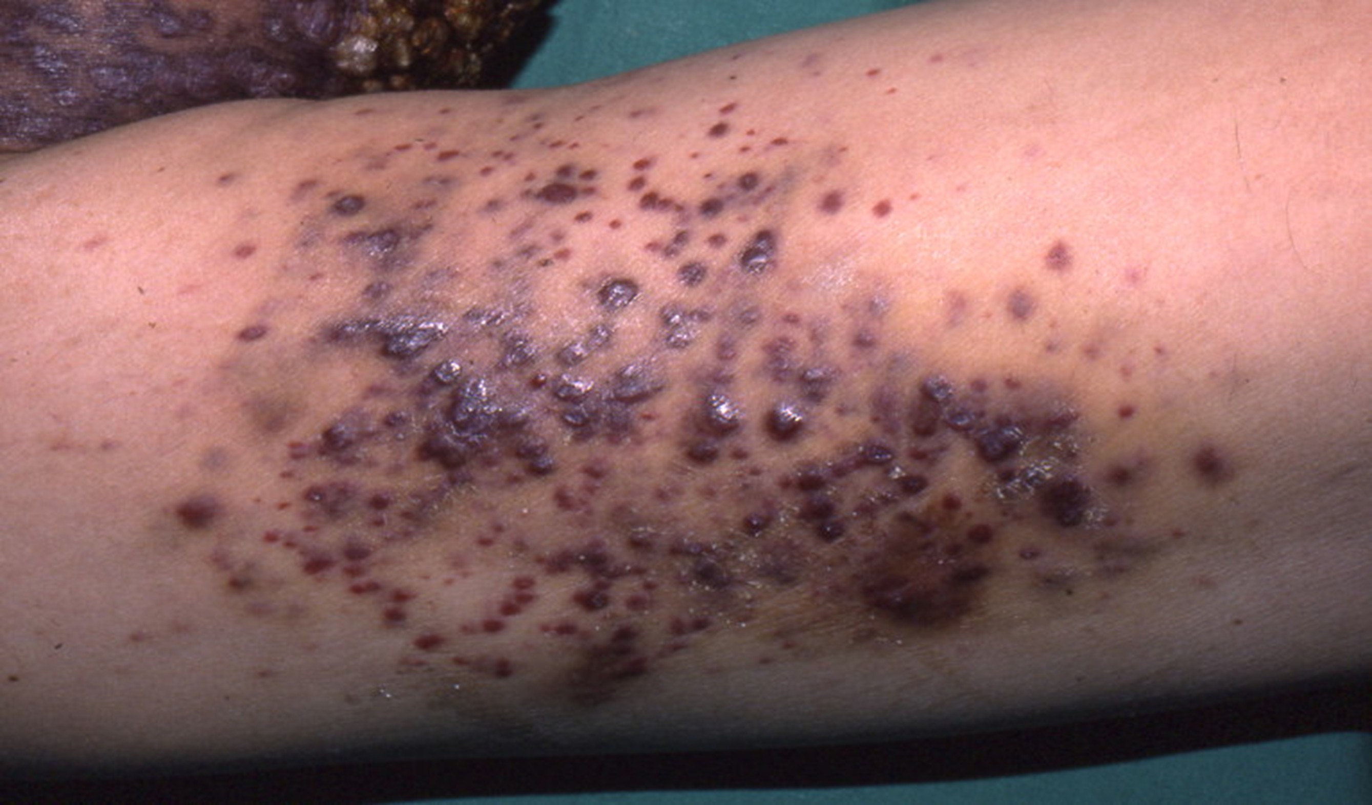 Lésions de sarcome de Kaposi chez une personne atteinte par le VIH.