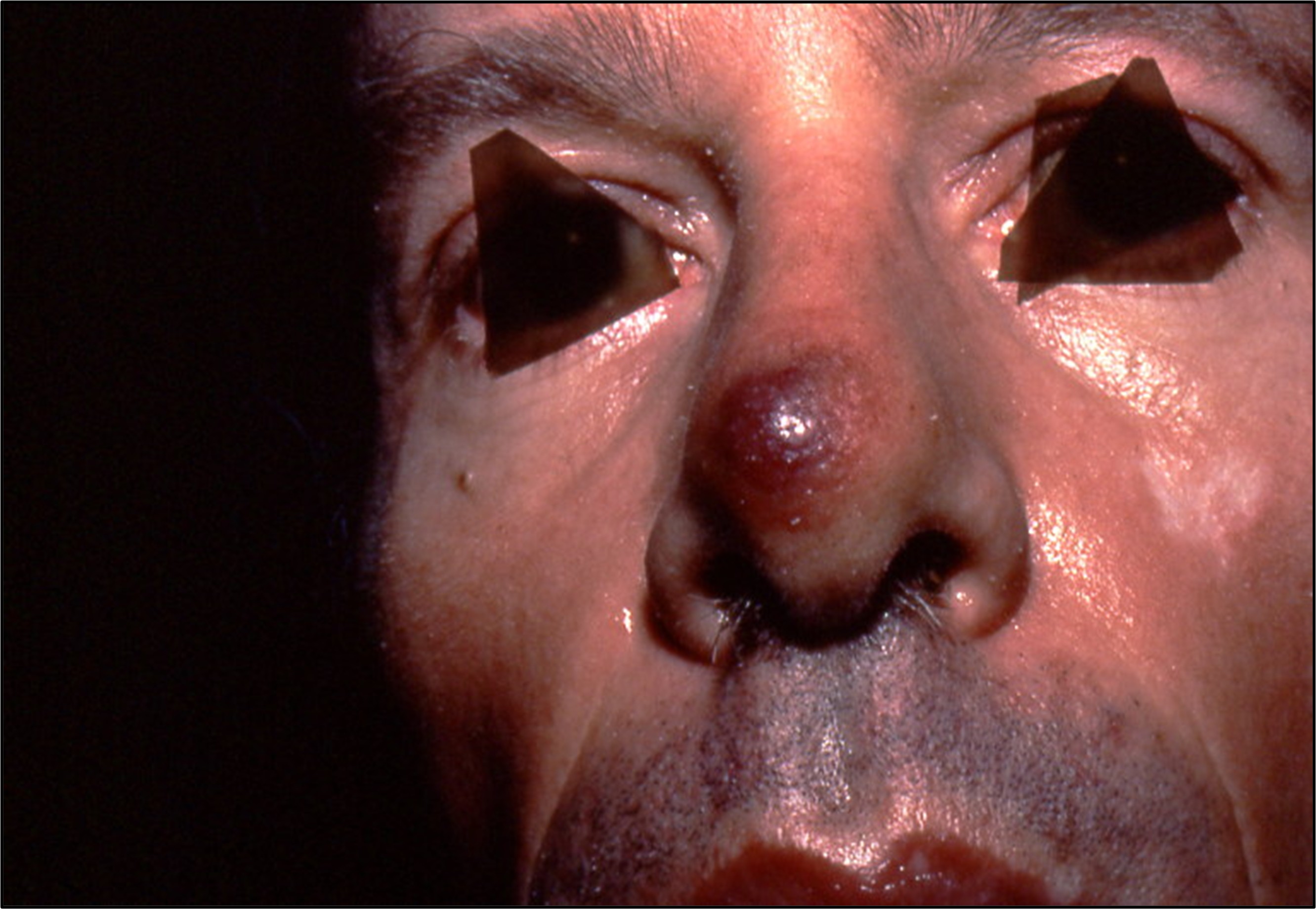 Lésions de sarcome de Kaposi chez une personne atteinte par le VIH.