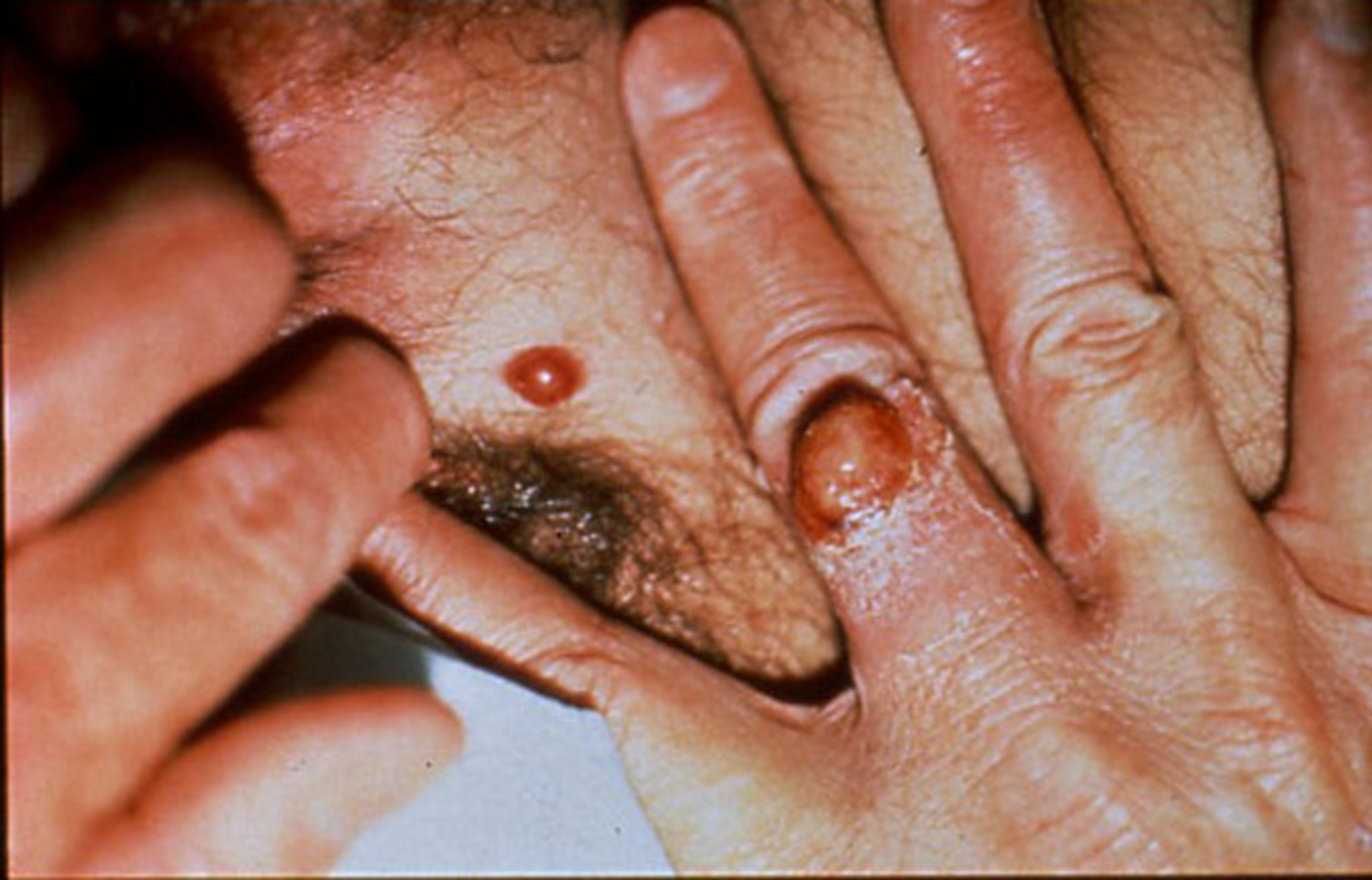 Angiomatose bacillaire.