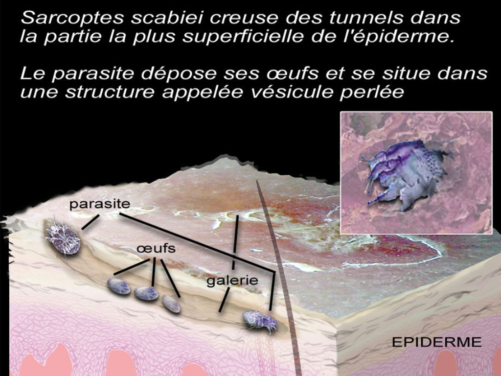 La gale au microsope