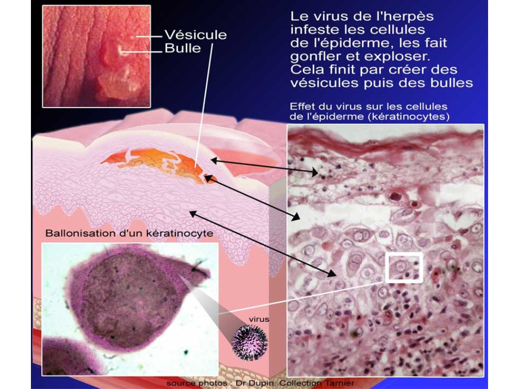 Vésicule d'herpès