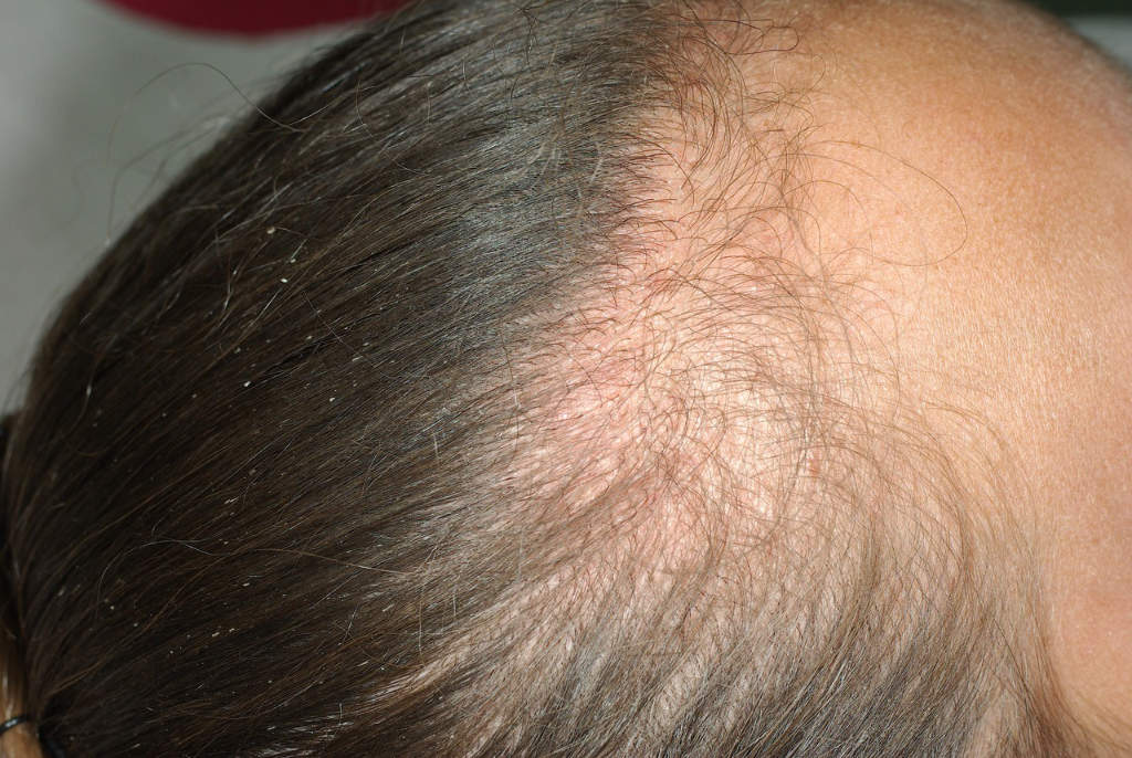 Alopécie de traction avec érythème (rouge) du cuir chevelu et gaines