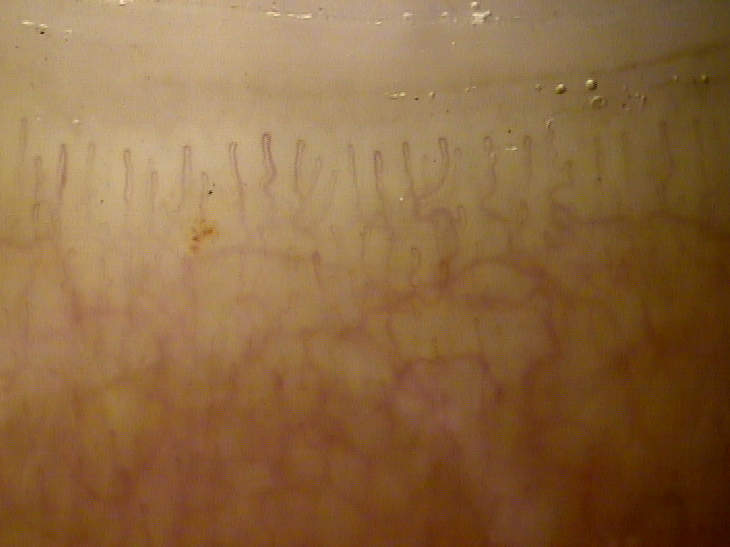 Capillaroscopie normale