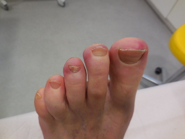 engelure-orteils DESSUS