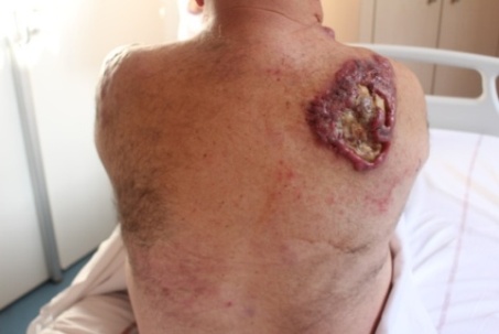 Lymphomes cutanés B de bon pronostic - Lymphome cutané B plus agressif à grandes cellules type jambe