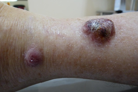Lymphomes cutanés B plus agressfis « B diffus type jambe »