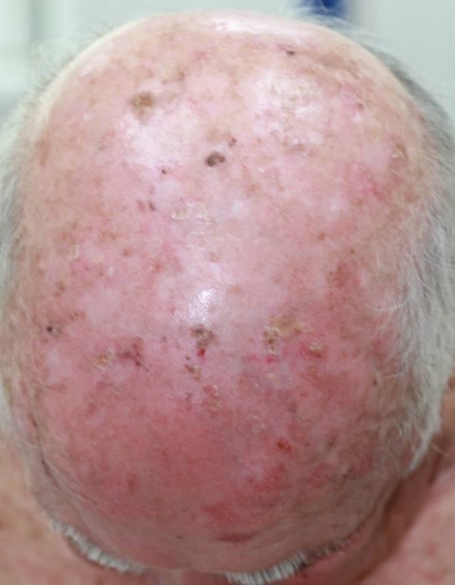 Kératose actinique menaçantes