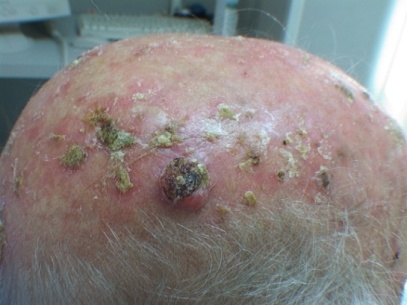 Kératose actinique multiples en champs de cancérisation