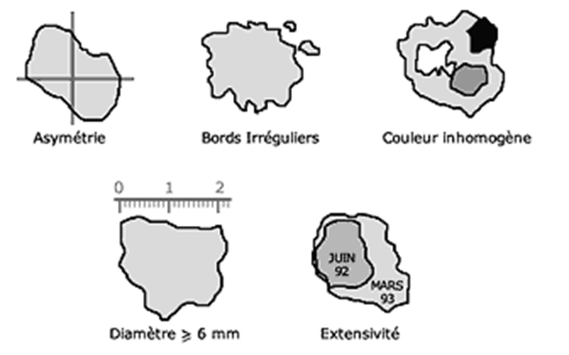 mélanome_règle-ABCDE