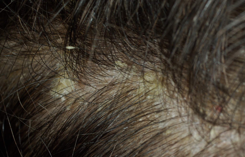 pellicule_dermite-séborrhéique