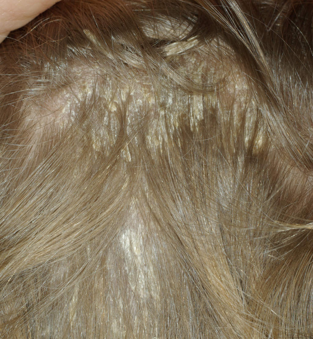 pellicule_fausse-teigne-amiantacée