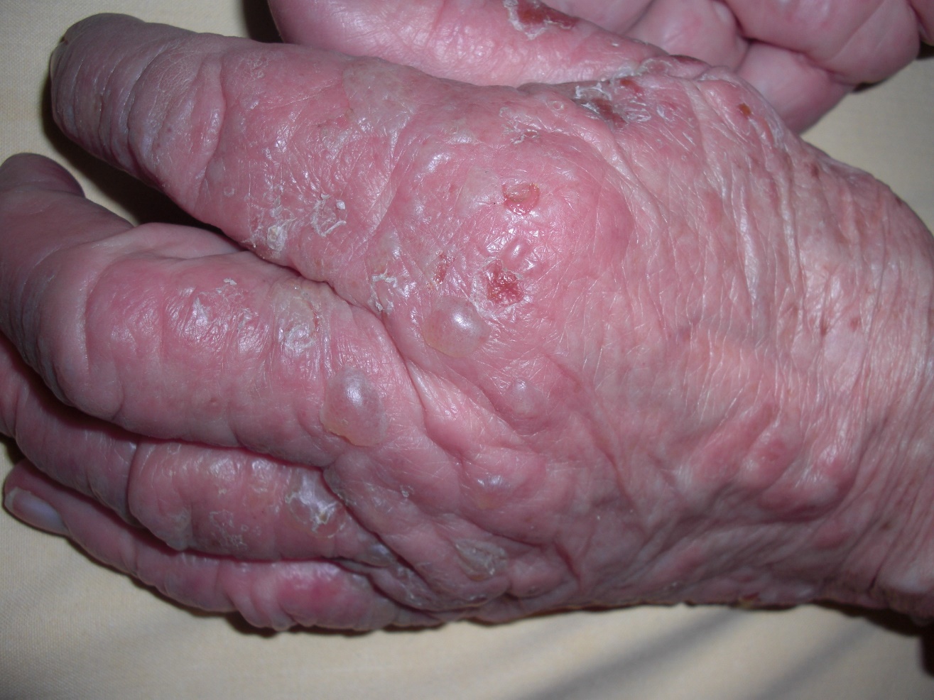 pemphigoïde-bulleuse