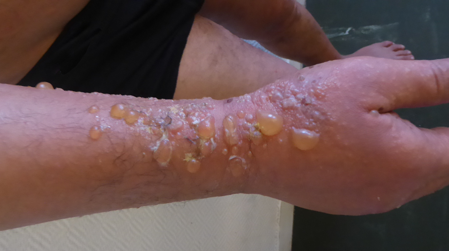 pemphigoïde-bulleuse