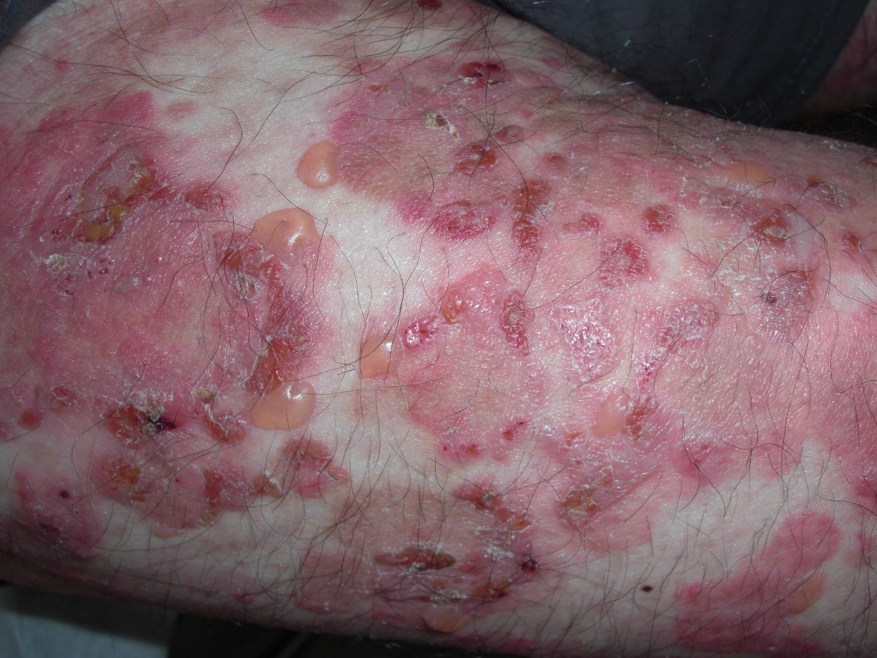 pemphigoïde-bulleuse