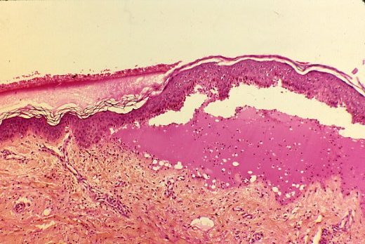Décollement entre l'épiderme et le derme à l'origine de la bulle