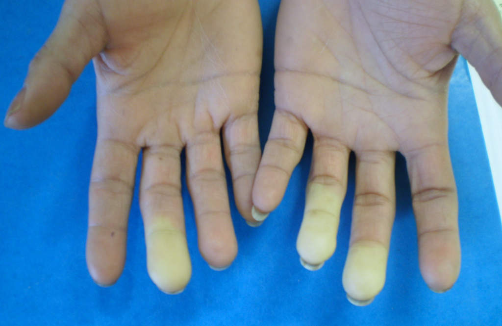 Phase syncopale du Raynaud