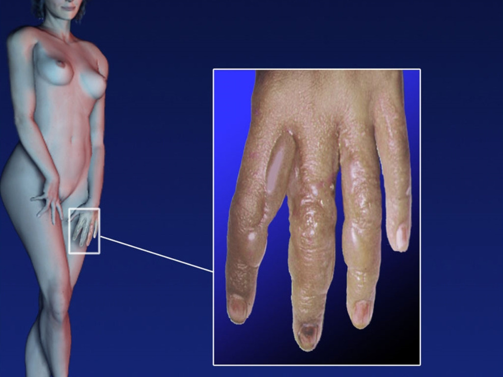 photosensibilisation