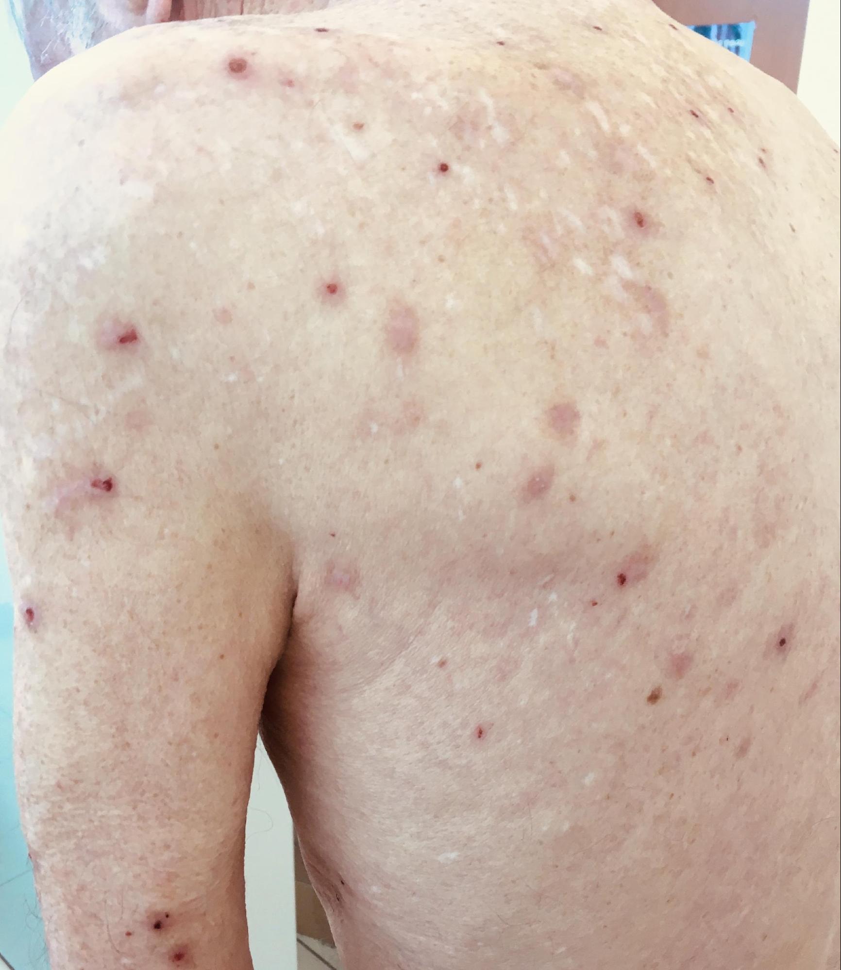 prurigo-chronique_cicatrice-dyschromique