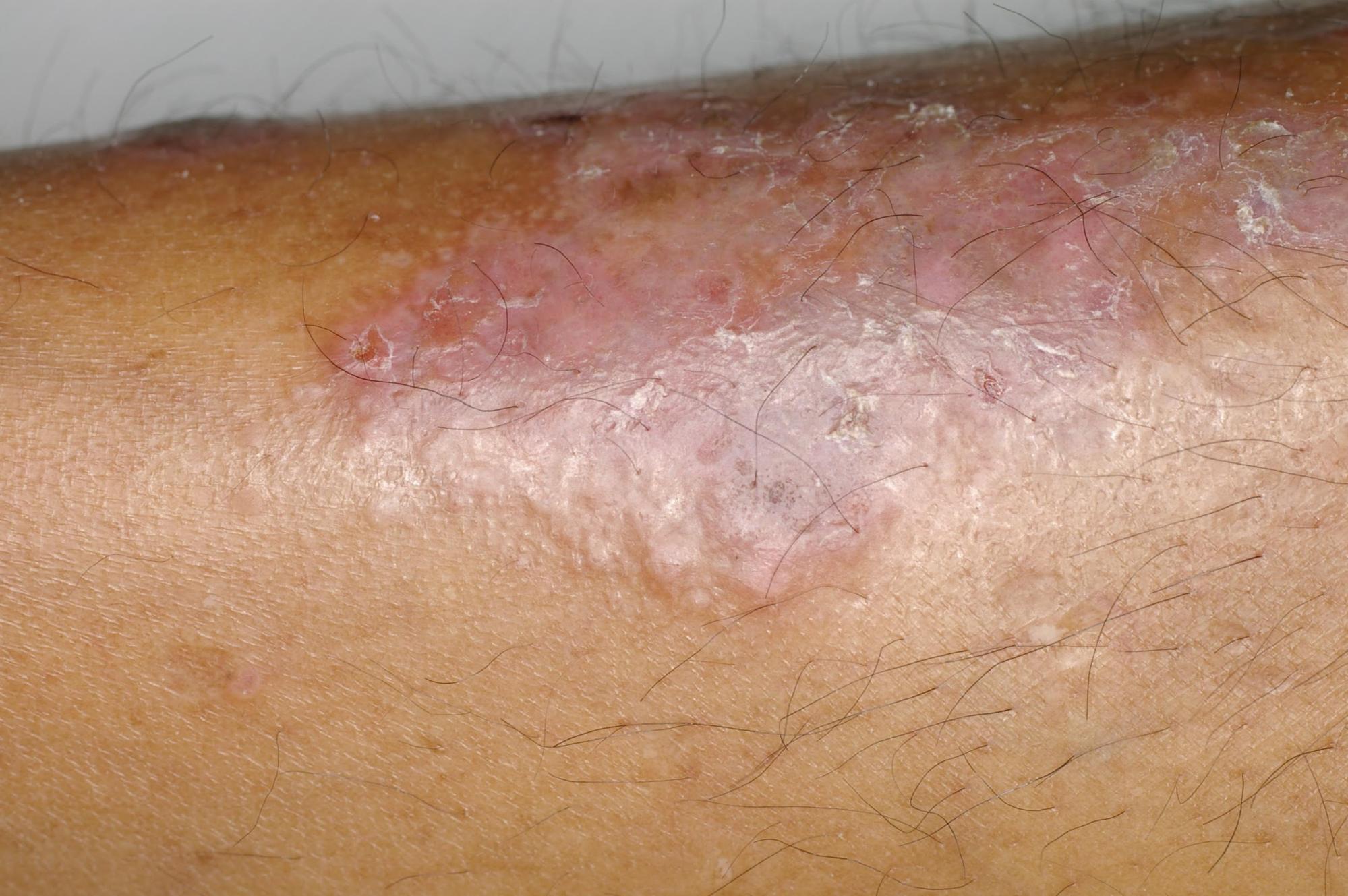 prurigo_en-plaque-lichénification