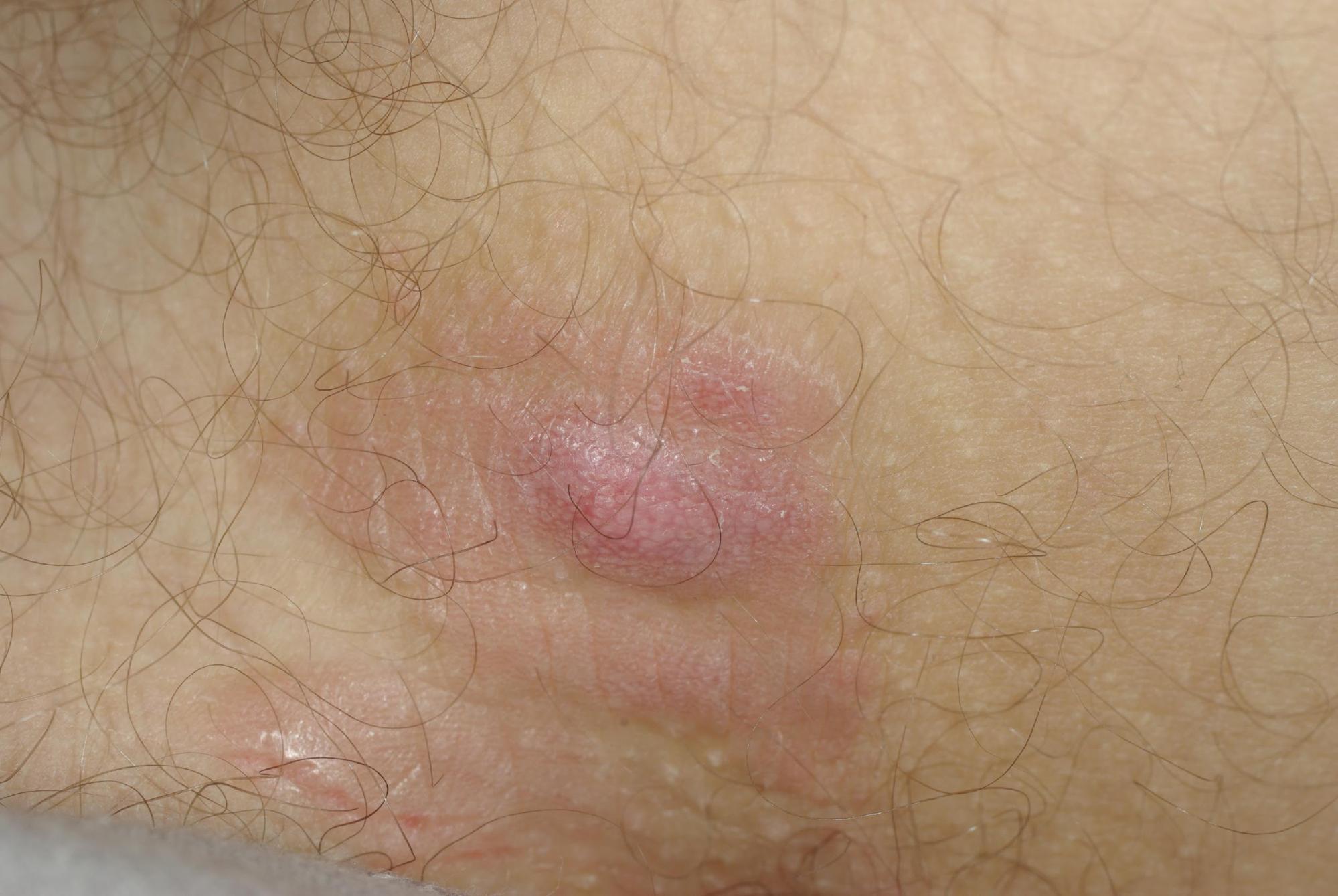 prurigo_en-plaque-lichénification