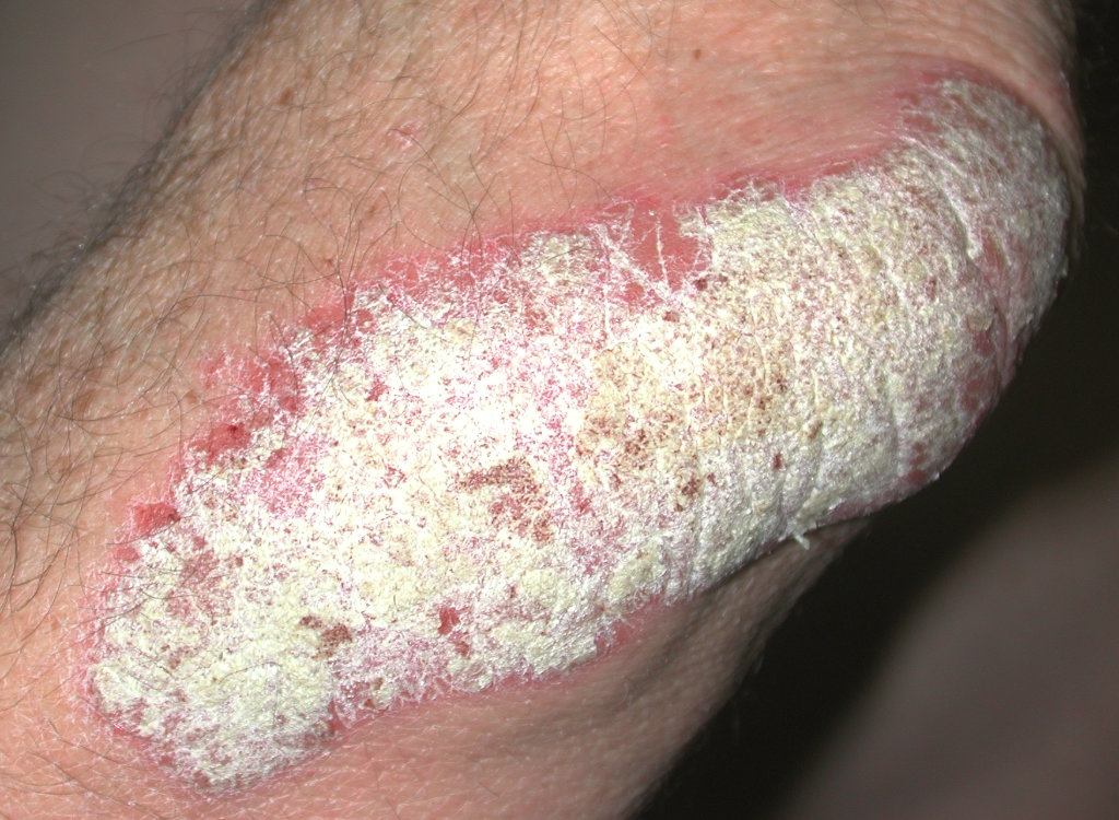 psoriasis-coude_