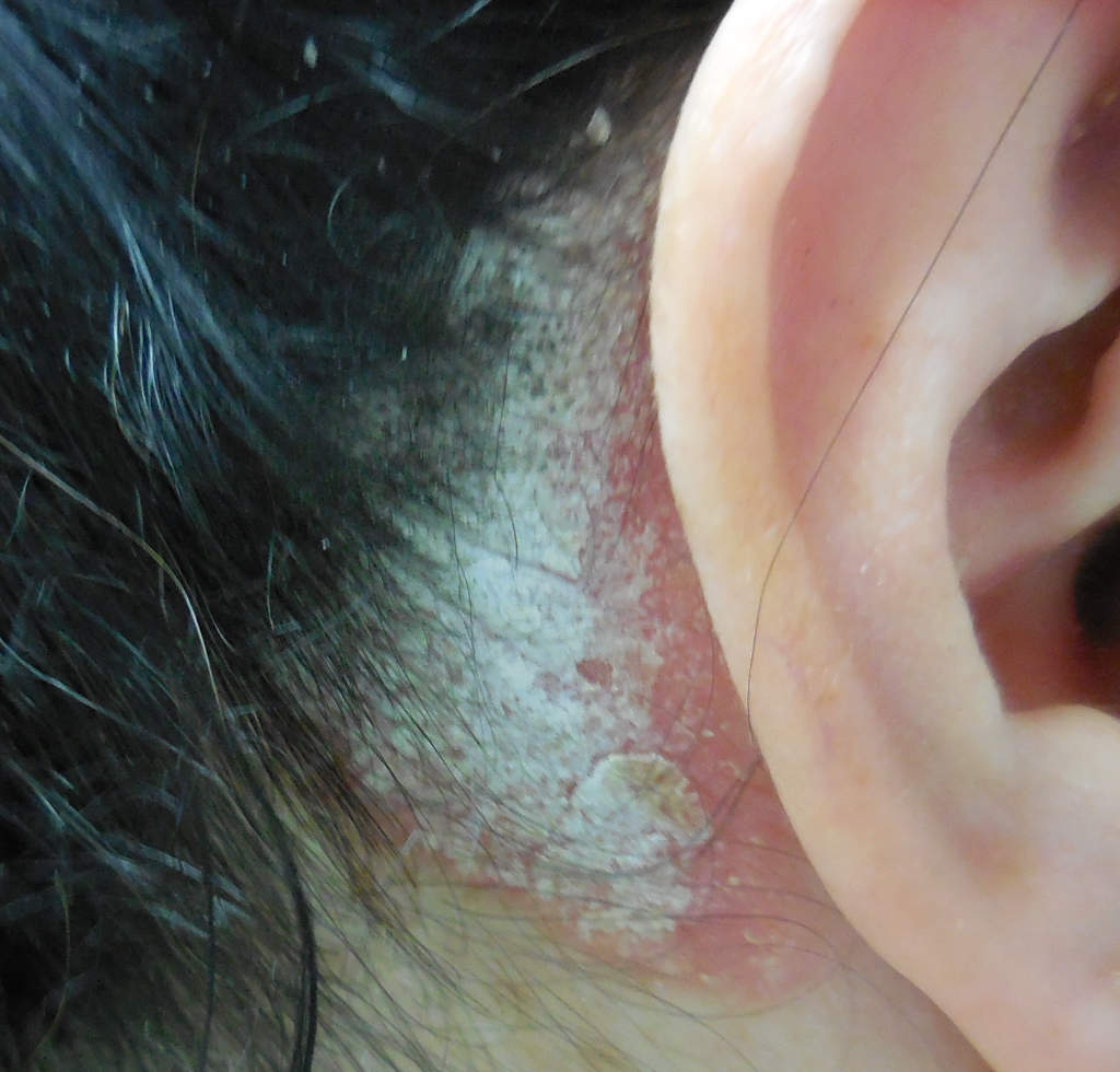 psoriasis-cuir-chevelu_