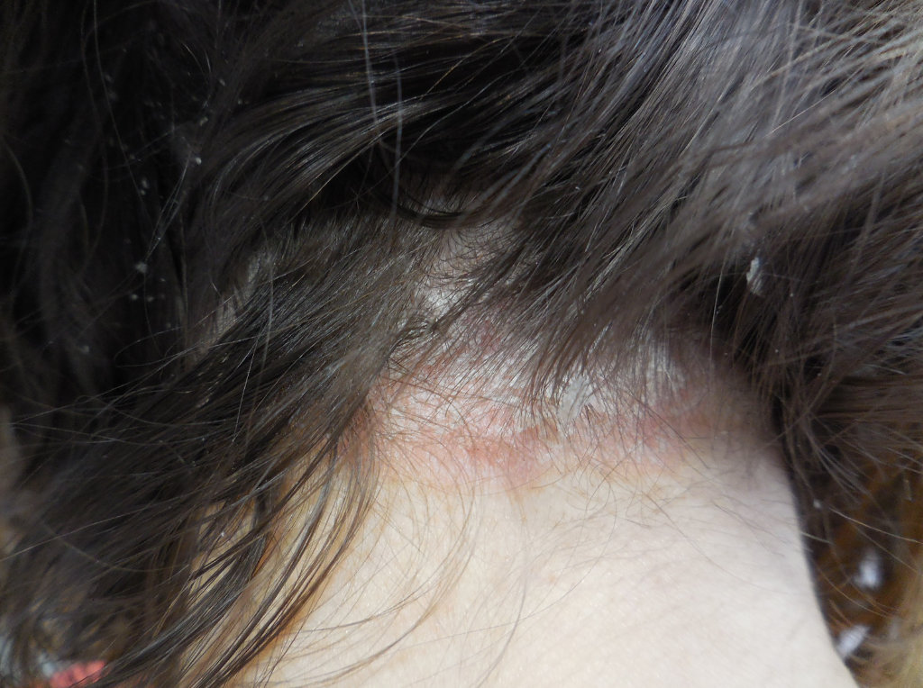 psoriasis-cuir-chevelu