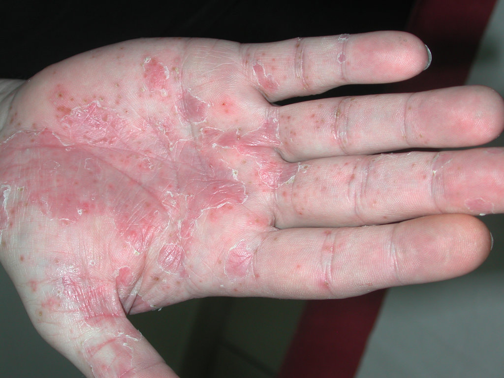 psoriasis-palmaire