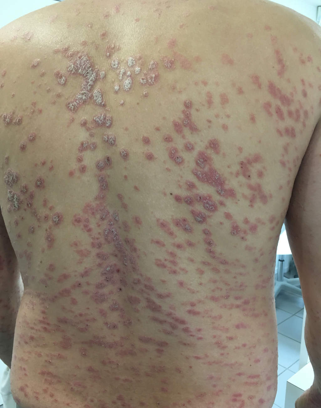 psoriasis_dos