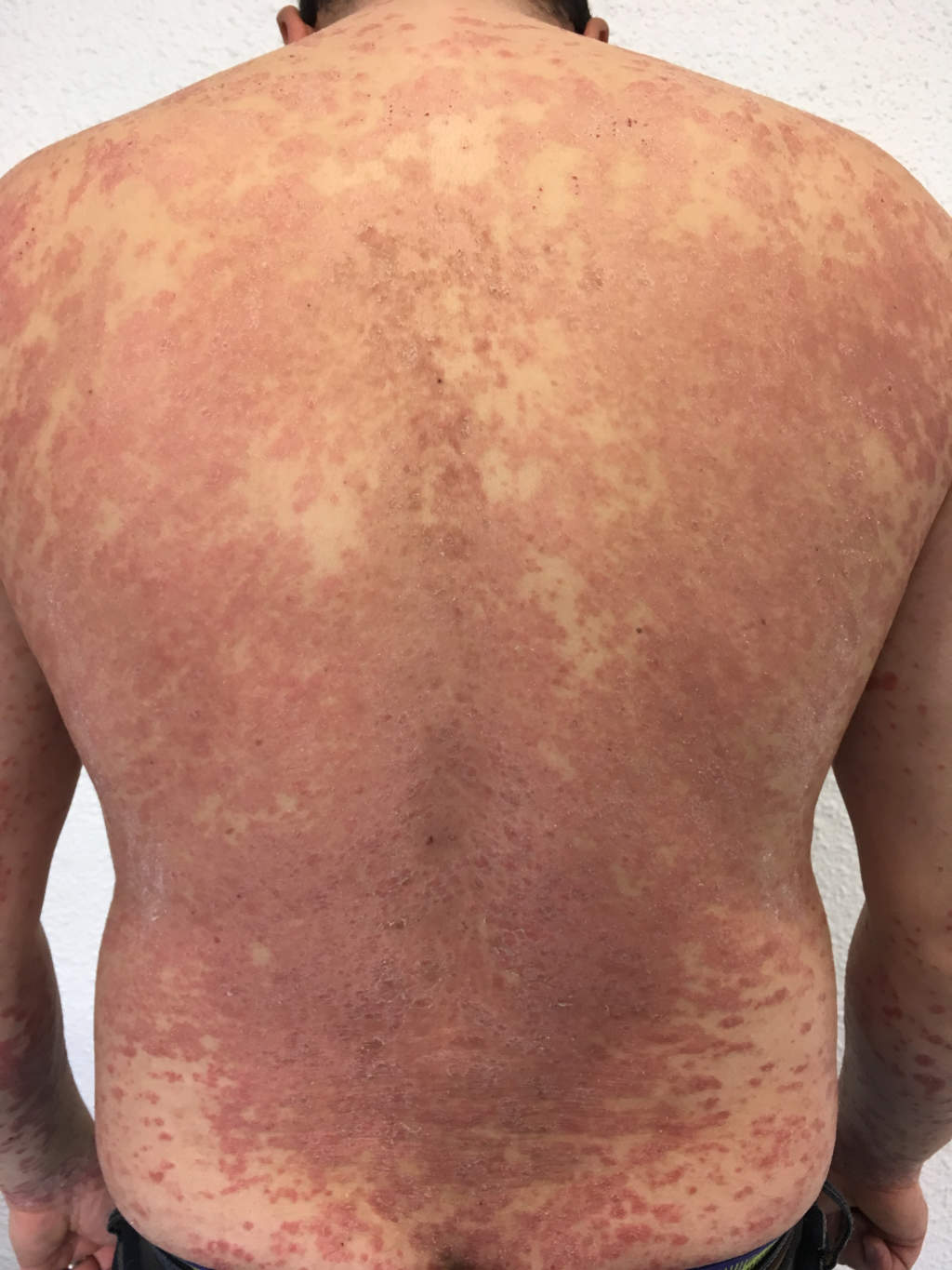 psoriasis_dos